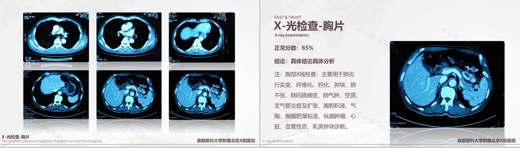 首都医科大学附属北京X医院病例汇报PPT模板-6